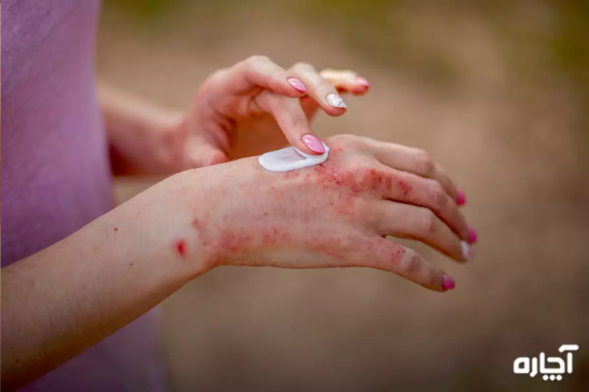 Women's hand eczema