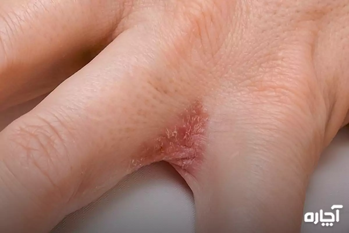 Women's hand eczema