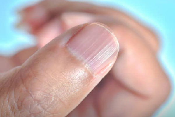 خطوط عمودی روی ناخن نشانه چیست؟